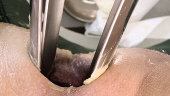 Doktor Ve Hemşire Hastayı Süper Fisting Ve Çift Fisting Yaparak Tatmin Ediyor